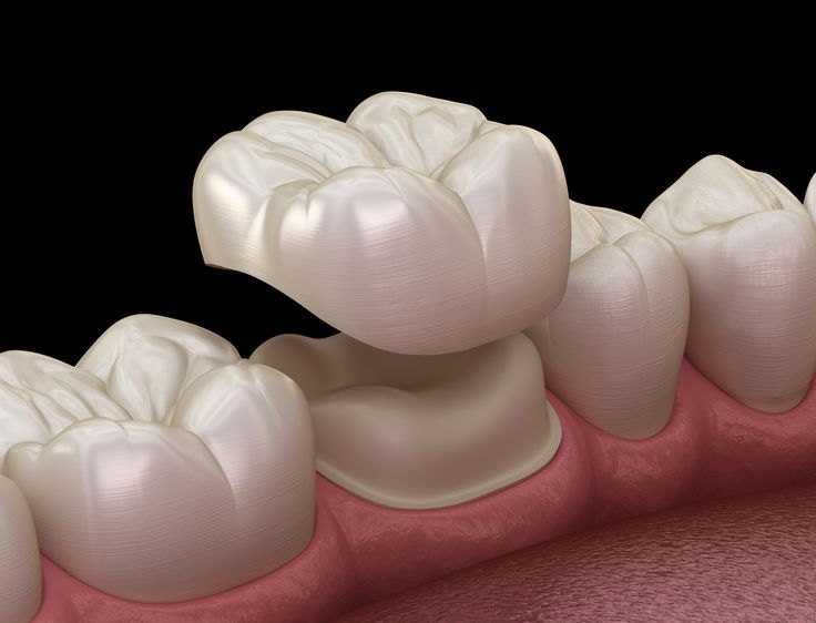 Ceramic Crown Treatment – Sanidhya Dental